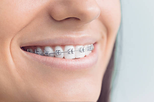 Dental Bonding in Florence Graham, CA